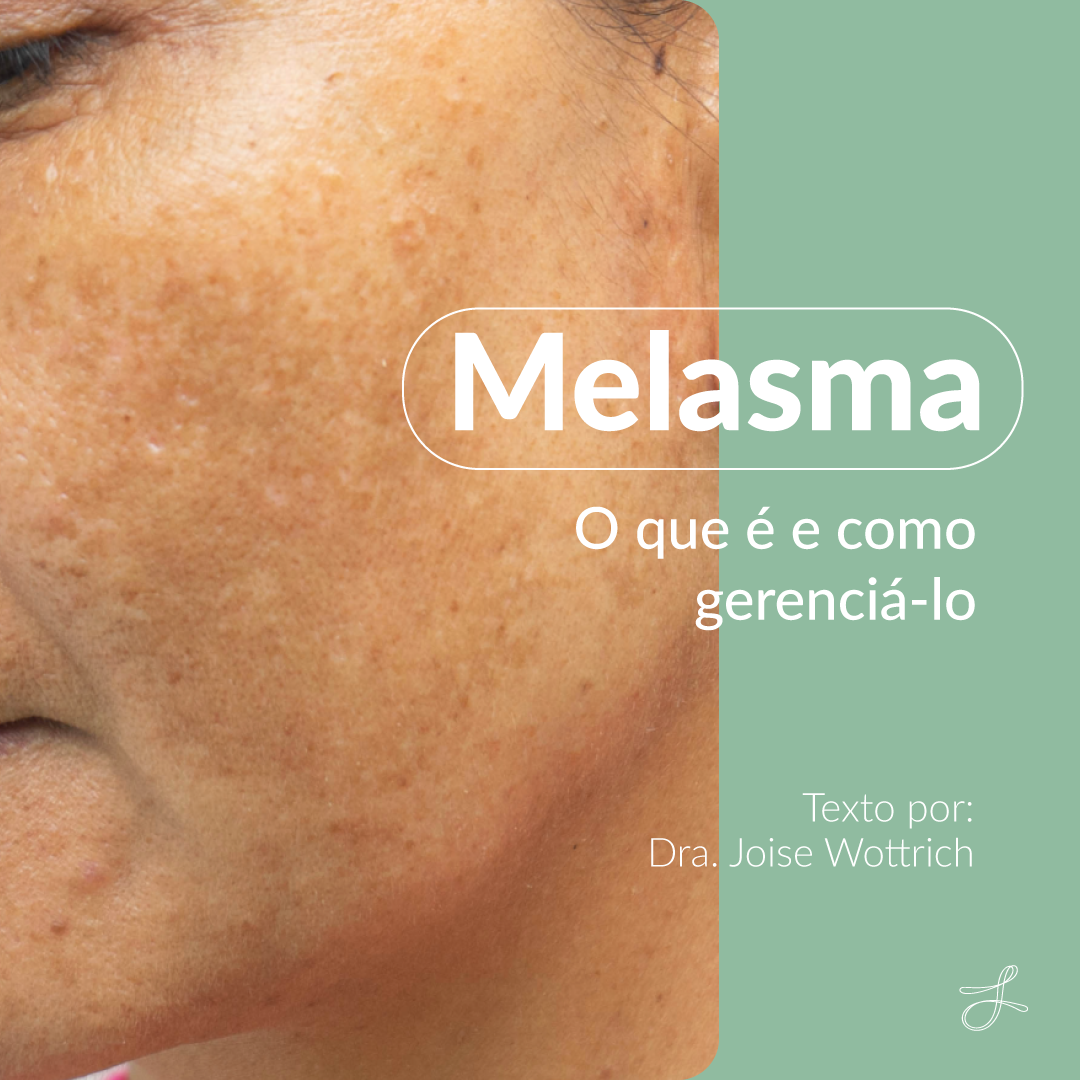 Melasma: o que é e como gerenciá-lo