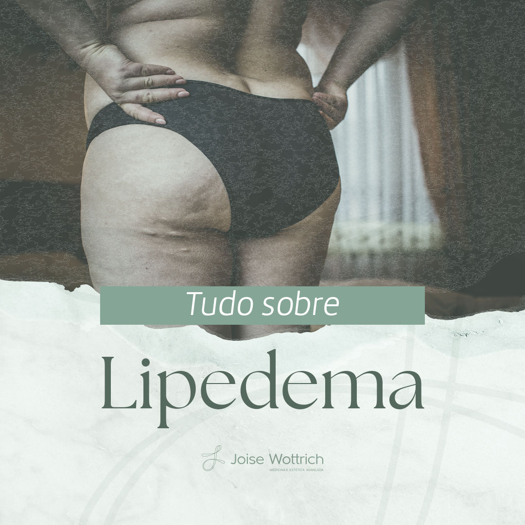 Tudo sobre Lipedema